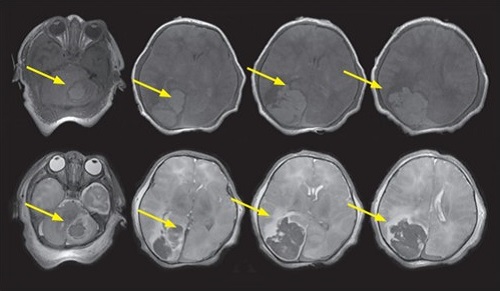 CS Image - Extensive Birth Trauma with HIE