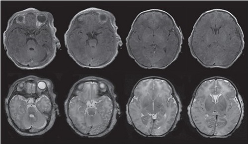 Partial Prolonged HIE - CS