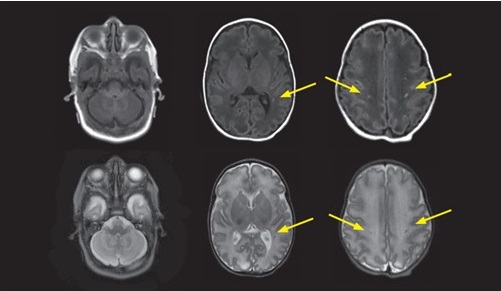 CS5 Image - Later Preterm with Unknown White Matter Injury