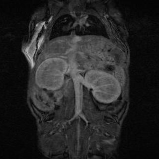 Retention-in-Kidneys